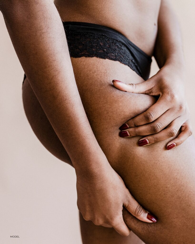 model showing thighs and stomach to indicate parts of the body that people may treat with Morpheus8